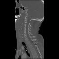 Cervical spine fractures with vertebral artery dissection (Radiopaedia 32135-33078 Sagittal bone window 16).jpg