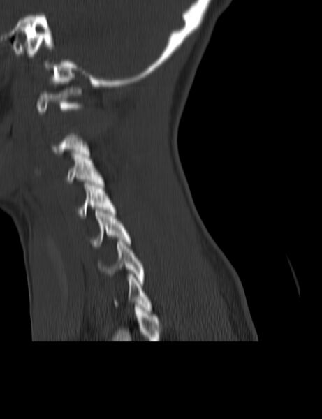 File:Cervical spine posterior ligamentous complex rupture (Radiopaedia 63486-72101 Sagittal bone window 3).jpg