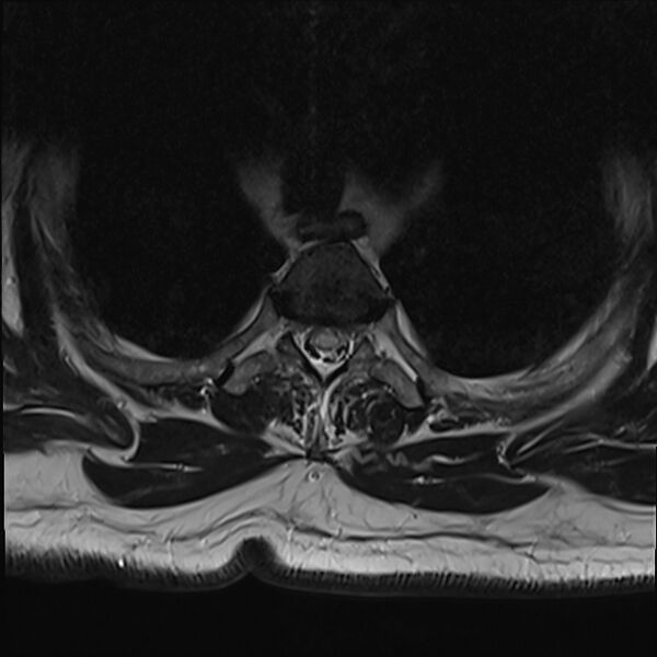 File:Cervical tumor-like myelopathy due to Type V dAVF (Radiopaedia 82461-96604 D 6).jpg