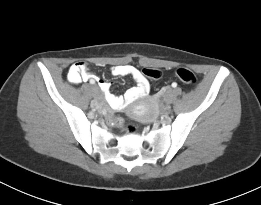 Cesarean scar endometriosis (Radiopaedia 82925-97262 A 68).jpg