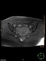 Cesarian scar endometriosis (Radiopaedia 68495-78066 Axial T1 fat sat 14).jpg