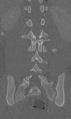 Chance fracture (Radiopaedia 40360-42912 Coronal bone window 46).png