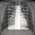 Chest x-ray - circulation (Radiopaedia 32664-33633 A 1).jpg