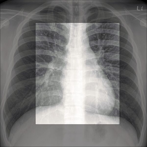 File:Chest x-ray - circulation (Radiopaedia 32664-33633 A 1).jpg