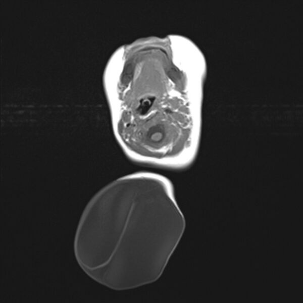 File:Chiari III malformation with occipital encephalocele (Radiopaedia 79446-92559 Axial T1 7).jpg