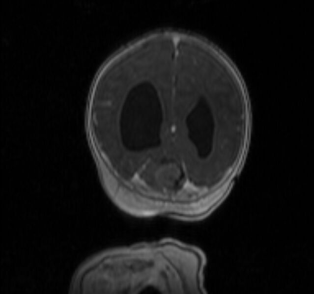 File:Chiari III malformation with occipital encephalocele (Radiopaedia 79446-92559 Coronal T1 C+ mpr 36).jpg
