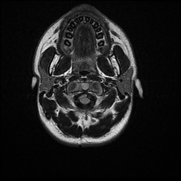 File:Chiasmatic-hypothalamic juvenile pilocytic astrocytoma (Radiopaedia 78533-91235 Axial FLAIR 1).jpg