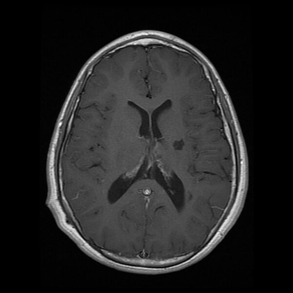 File:Chiasmatic-hypothalamic juvenile pilocytic astrocytoma (Radiopaedia 78533-91236 Axial T1 C+ 17).jpg