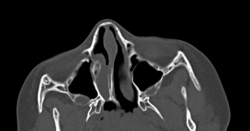 Choanal atresia (Radiopaedia 51295-56972 Axial bone window 24).jpg