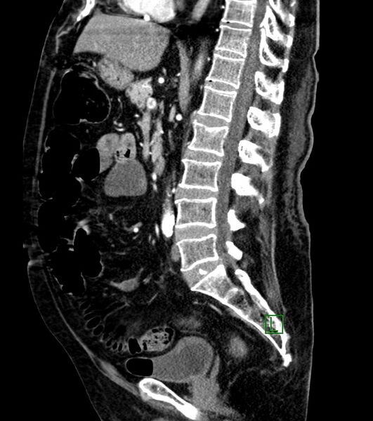 File:Cholangiocarcinoma with cerebral metastases (Radiopaedia 83519-98629 F 61).jpg
