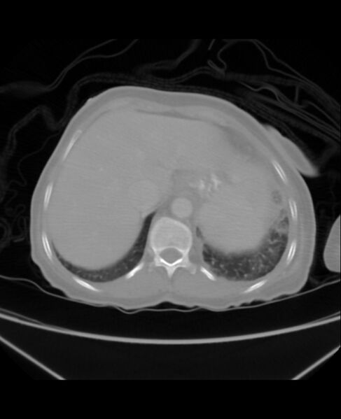 File:Chondrosarcoma (Radiopaedia 79427-92535 Axial lung window 47).jpg