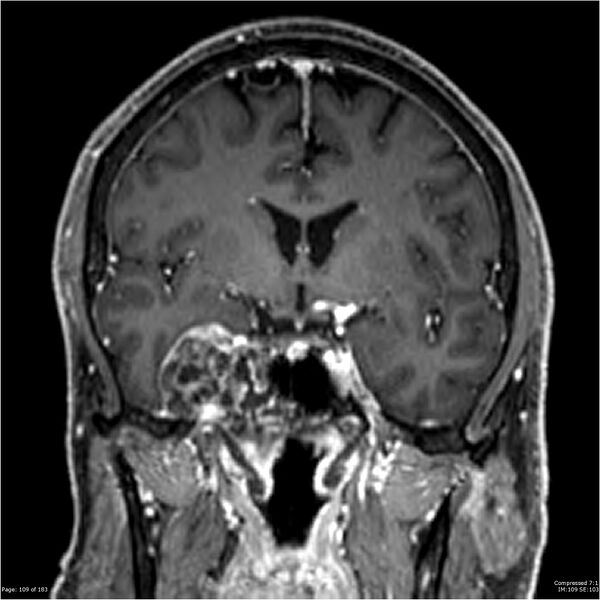 File:Chondrosarcoma of skull base- grade II (Radiopaedia 40948-43654 Coronal T1 C+ 20).jpg
