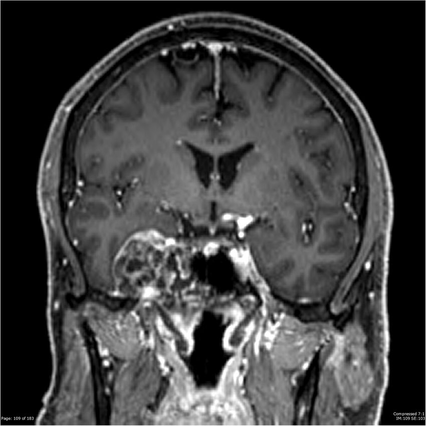 Chondrosarcoma of skull base- grade II (Radiopaedia 40948-43654 Coronal T1 C+ 20).jpg
