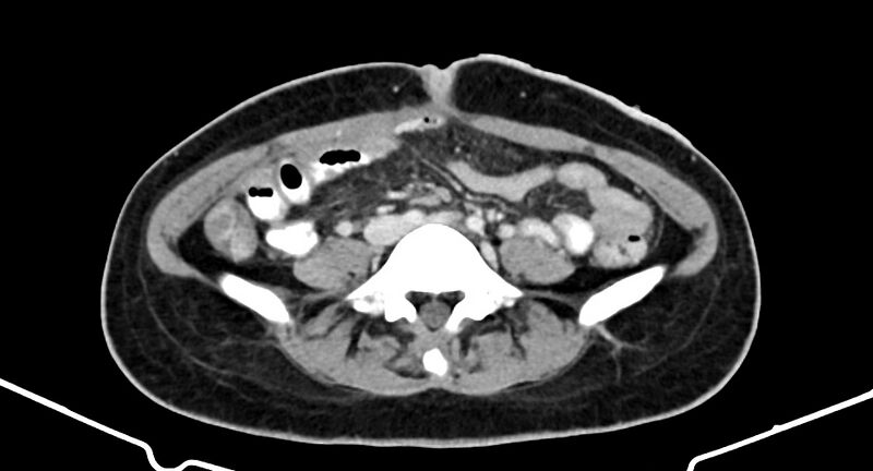 File:Choriocarcinoma liver metastases (Radiopaedia 74768-85766 A 134).jpg