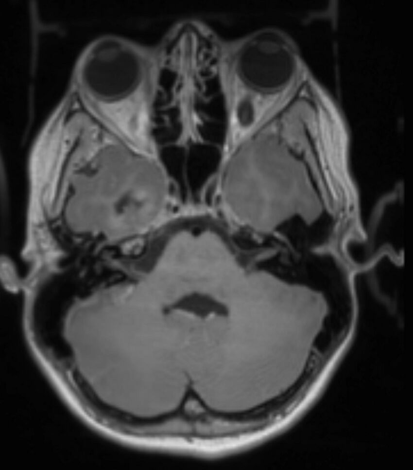 Choroid plexus carcinoma (Radiopaedia 91013-108553 Axial T1 C+ 97).jpg