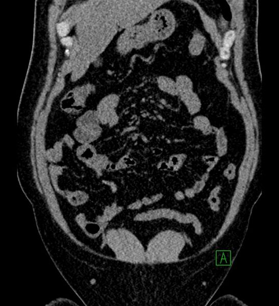 File:Chromophobe renal cell carcinoma (Radiopaedia 84286-99573 Coronal non-contrast 43).jpg