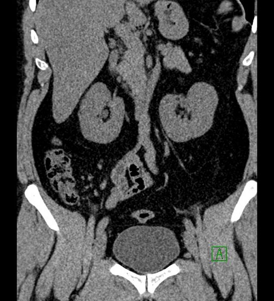 File:Chromophobe renal cell carcinoma (Radiopaedia 84286-99573 Coronal non-contrast 83).jpg