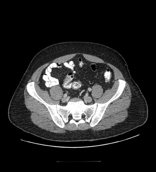 File:Chromophobe renal cell carcinoma (Radiopaedia 84337-99644 C 102).jpg