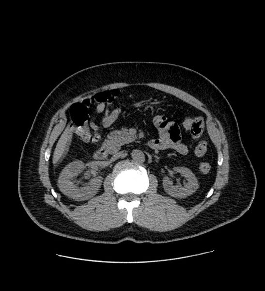 File:Chromophobe renal cell carcinoma (Radiopaedia 84337-99693 Axial non-contrast 53).jpg