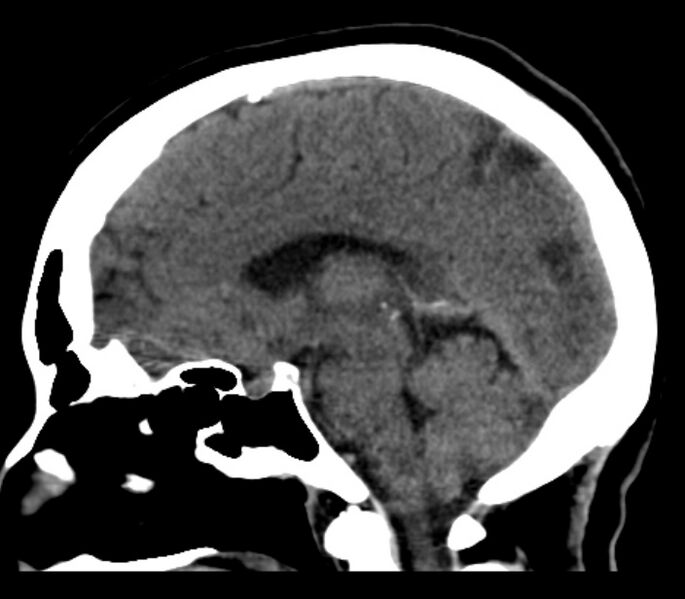 File:Chronic bilateral occipital lobe infarcts (Radiopaedia 31276-31996 C 21).jpg
