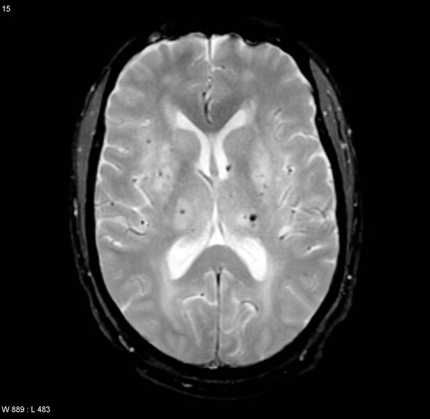 File:Chronic hypertensive encephalopathy (Radiopaedia 4564-6686 Axial Gradient Echo 10).jpg
