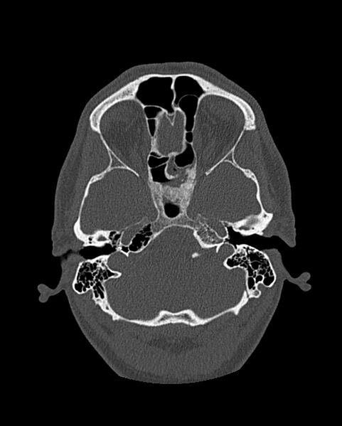 File:Chronic maxillary sinusitis caused by a foreign body (Radiopaedia 58521-65676 Axial bone window 230).jpg