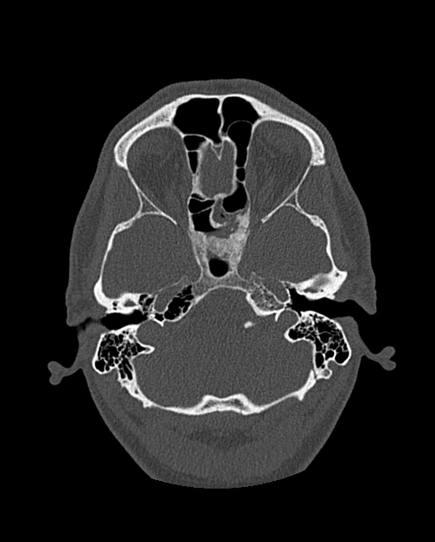 Chronic maxillary sinusitis caused by a foreign body (Radiopaedia 58521-65676 Axial bone window 230).jpg