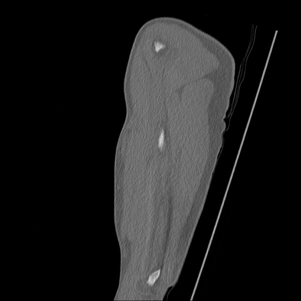 File:Chronic osteomyelitis (Radiopaedia 67597-76998 Sagittal bone window 20).jpg