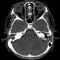 Chronic otomastoiditis (Radiopaedia 27138-27309 Axial non-contrast 34).jpg
