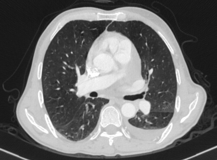 Chronic pulmonary embolism with bubbly consolidation (Radiopaedia 91248-108850 Axial lung window 80).jpg