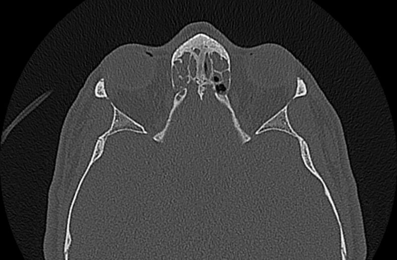 File:Chronic rhinosinusitis (Radiopaedia 65079-74075 Axial bone window 61).jpg