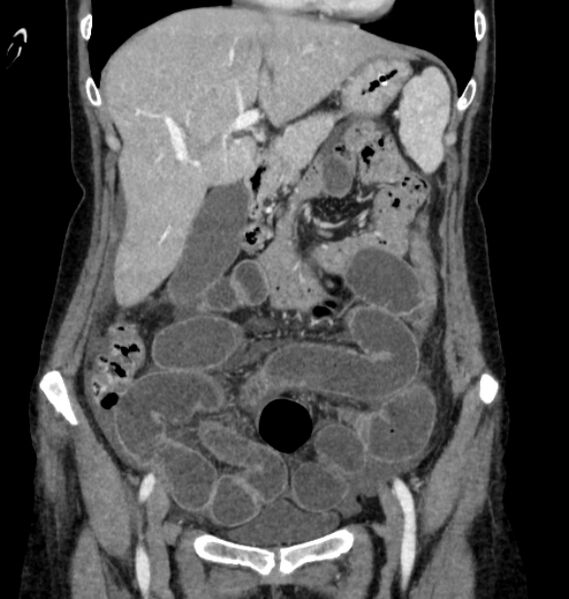 File:Closed loop small bowel obstruction (Radiopaedia 71211-81508 B 31).jpg