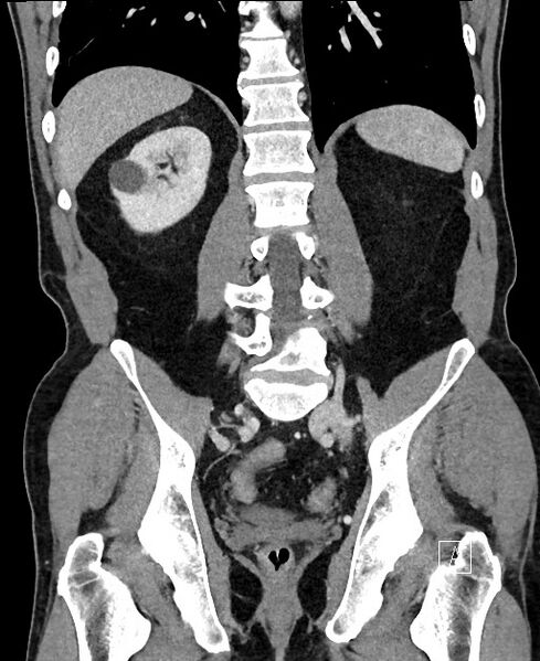 File:Closed loop small bowel obstruction - internal hernia (Radiopaedia 57806-64778 A 82).jpg