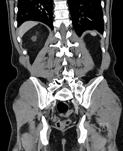 File:Closed loop small bowel obstruction - internal hernia (Radiopaedia 57806-64778 A 92).jpg
