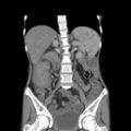 Colocolic fistula - Crohn disease (Radiopaedia 57063-63955 B 24).jpg