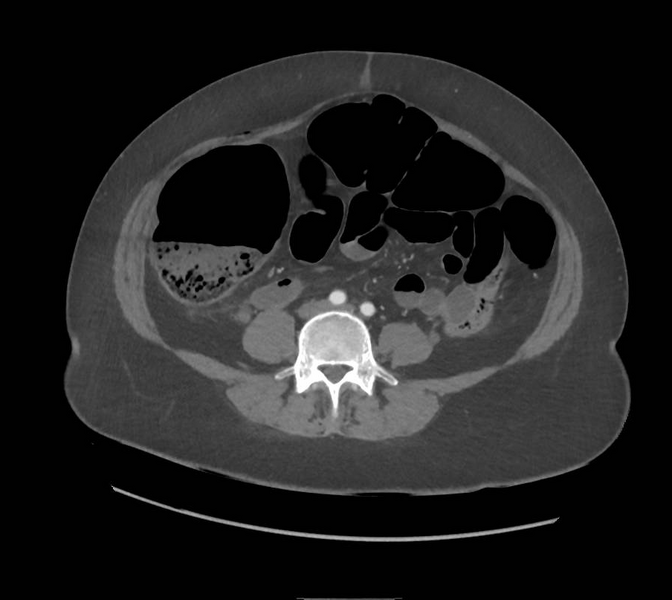 File:Colonic pseudo-obstruction (Radiopaedia 79752-92980 A 116).png