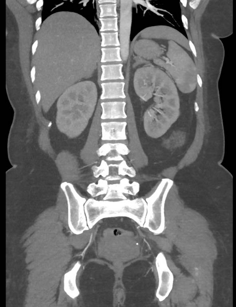 File:Colonic pseudo-obstruction (Radiopaedia 79752-92980 B 43).png
