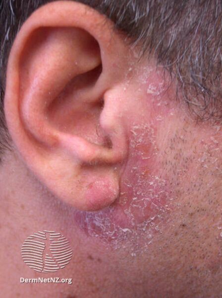 File:Epoxy resin allergy is diagnosed from the clinical history and by performing special allergy tests, called patchtests. (DermNet NZ dermatitis-epoxy).jpg