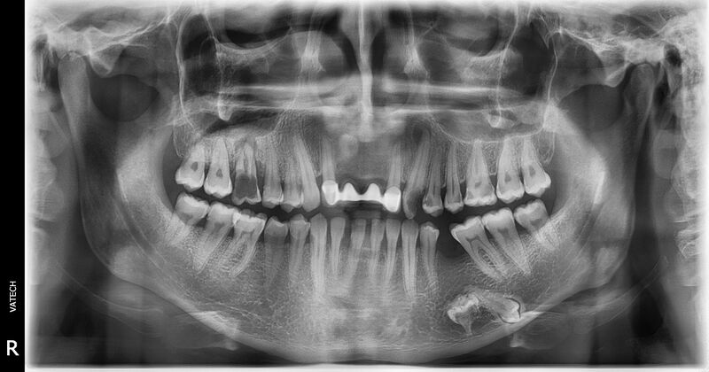 File:Intraosseous transposition of left mandibular premolars (Radiopaedia 67972).jpg