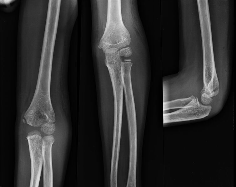 File:Lateral humeral condylar fracture (Radiopaedia 25937).jpg