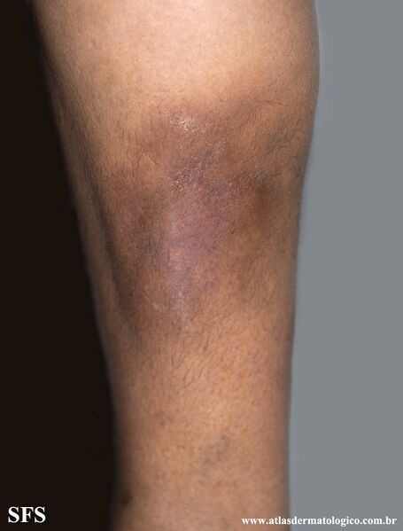 File:Lipodermatosclerosis (Dermatology Atlas 3).jpg