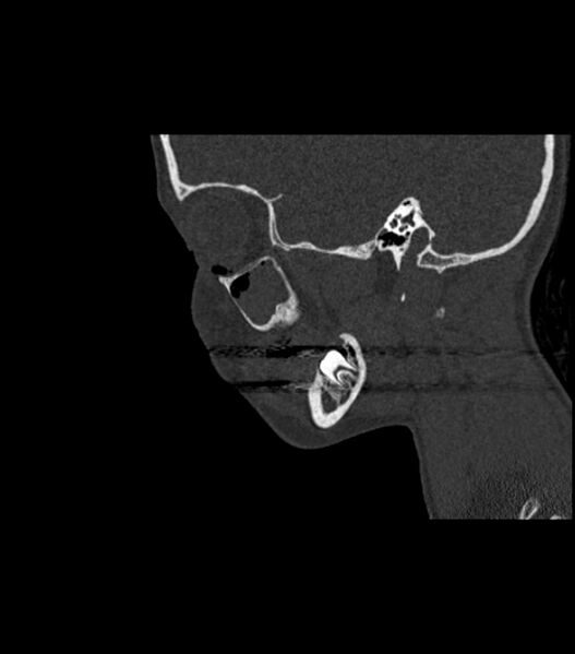 File:Nasoorbitoethmoid fracture (Radiopaedia 90044-107205 Sagittal bone window 104).jpg