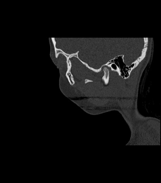 File:Nasoorbitoethmoid fracture (Radiopaedia 90044-107205 Sagittal bone window 117).jpg
