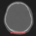 Nasopharyngeal carcinoma recurrence - skull base destruction (Radiopaedia 29107-29490 Axial bone window 48).jpg