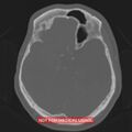 Nasopharyngeal carcinoma recurrence - skull base destruction (Radiopaedia 29107-29490 Axial bone window 65).jpg