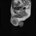 Necrotizing epididymo-orchitis with intra-testicular abscess (Radiopaedia 29397-29860 Sagittal T1 C+ 12).jpg