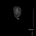Neonatal neuroblastoma (Radiopaedia 56651-63438 Coronal non-contrast 2).jpg