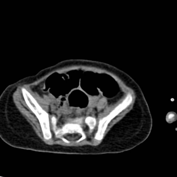 File:Neuroblastoma with skull metastases (Radiopaedia 30326-30960 Axial non-contrast 48).jpg