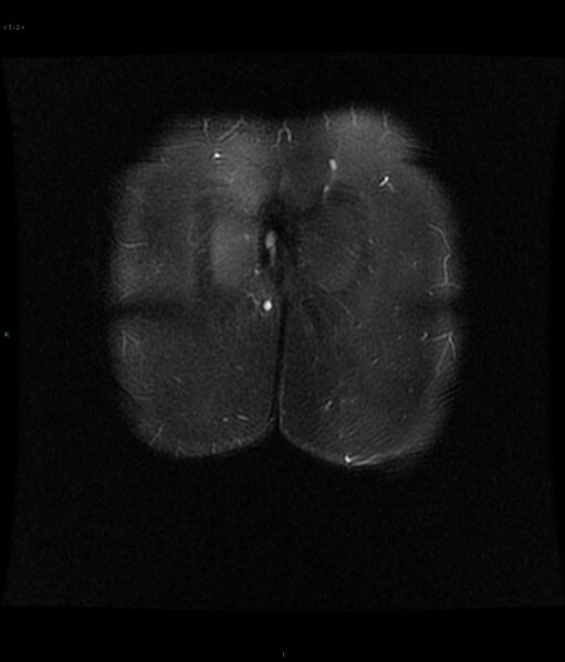 File:Neurofibromatosis type 1 (Radiopaedia 36933-38560 Coronal STIR 2).jpg