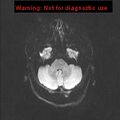 Neuroglial cyst (Radiopaedia 10713-11184 Axial DWI 40).jpg